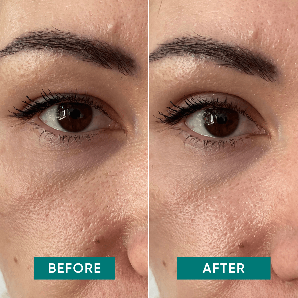 APRICOT Eyelid Tapes – Direct Liftend Effect voor Hangende Oogleden