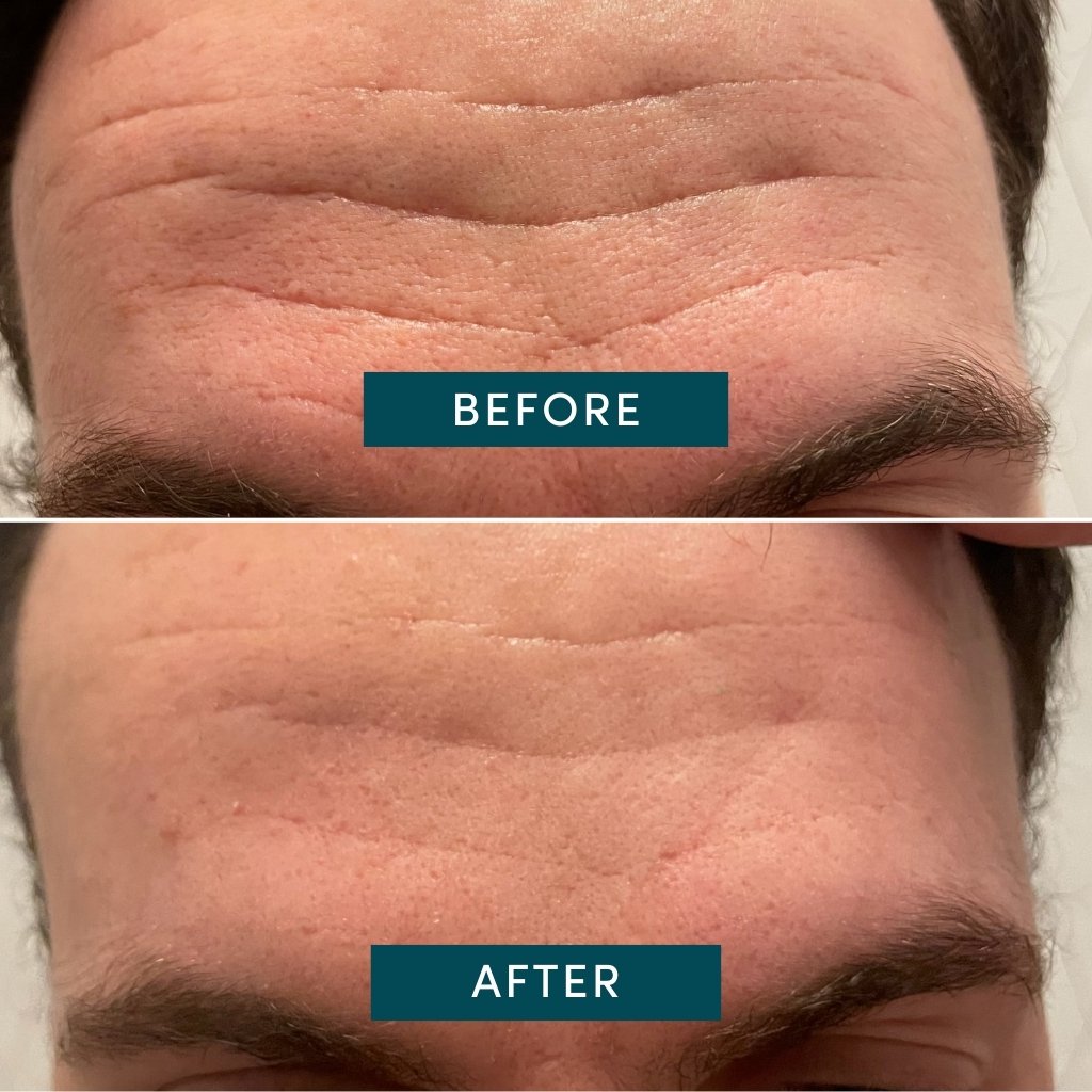 APRICOT Cotton Facial Patches with Niacinamide - Mini Pack