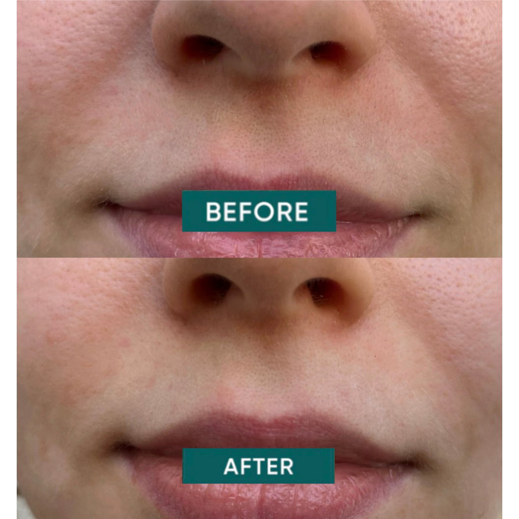 APRICOT Katoenen mondpleisters met Niacinamide