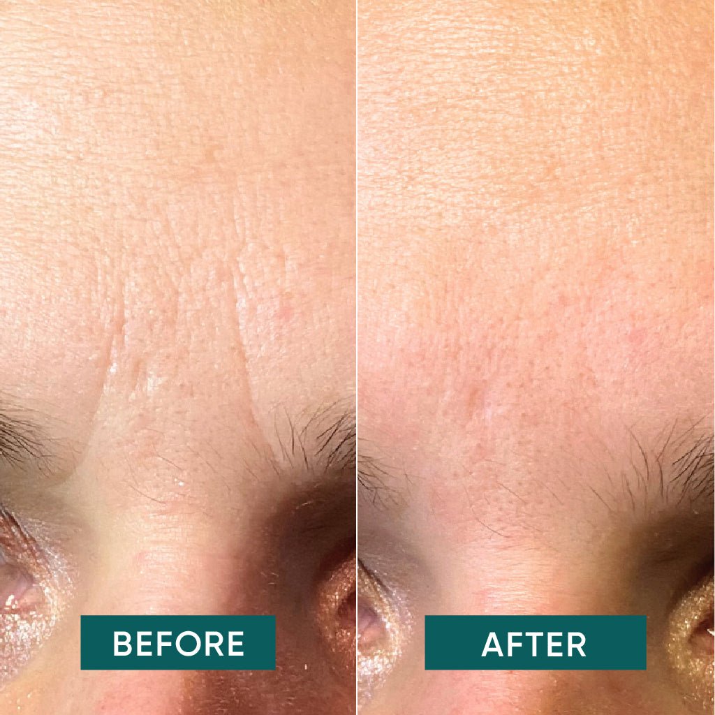 APRICOT Cotton Facial Patches – ectoin anti-rimpel voorhoofd & fronslijnen