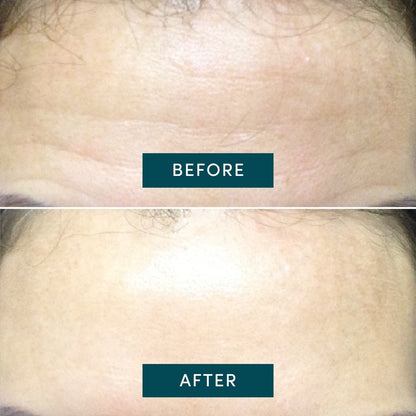 APRICOT Reusable Forehead Pad – Hexapeptide Anti-Aging Technologie