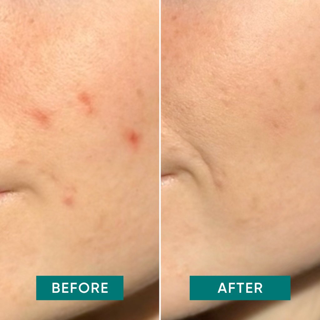 APRICOT Pimple Patches – Snelle & Kalmerende Anti-Puistjes Pleisters