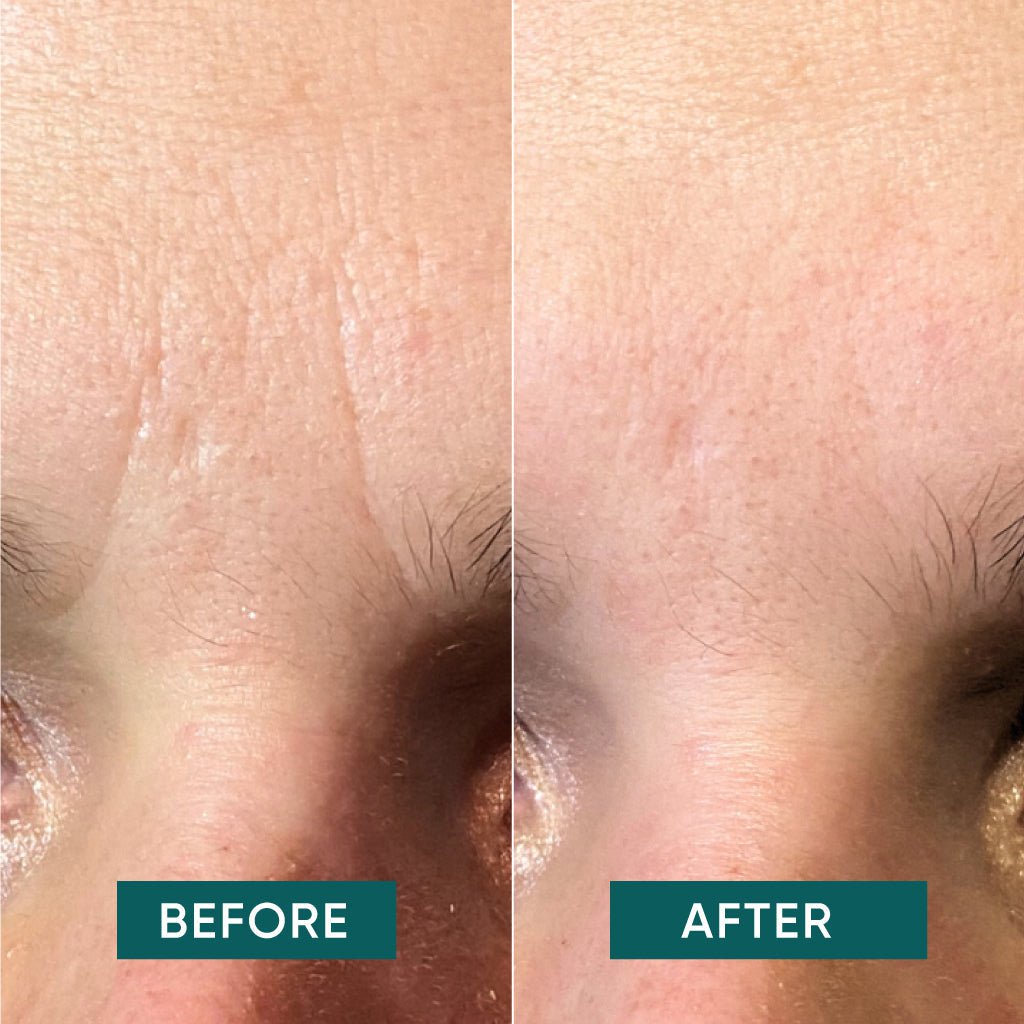 APRICOT Cotton Facial Patches – hyaluron anti-rimpel voorhoofd & fronslijnen